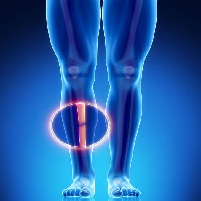 Leg Length Discrepancy Exercises For Injuries