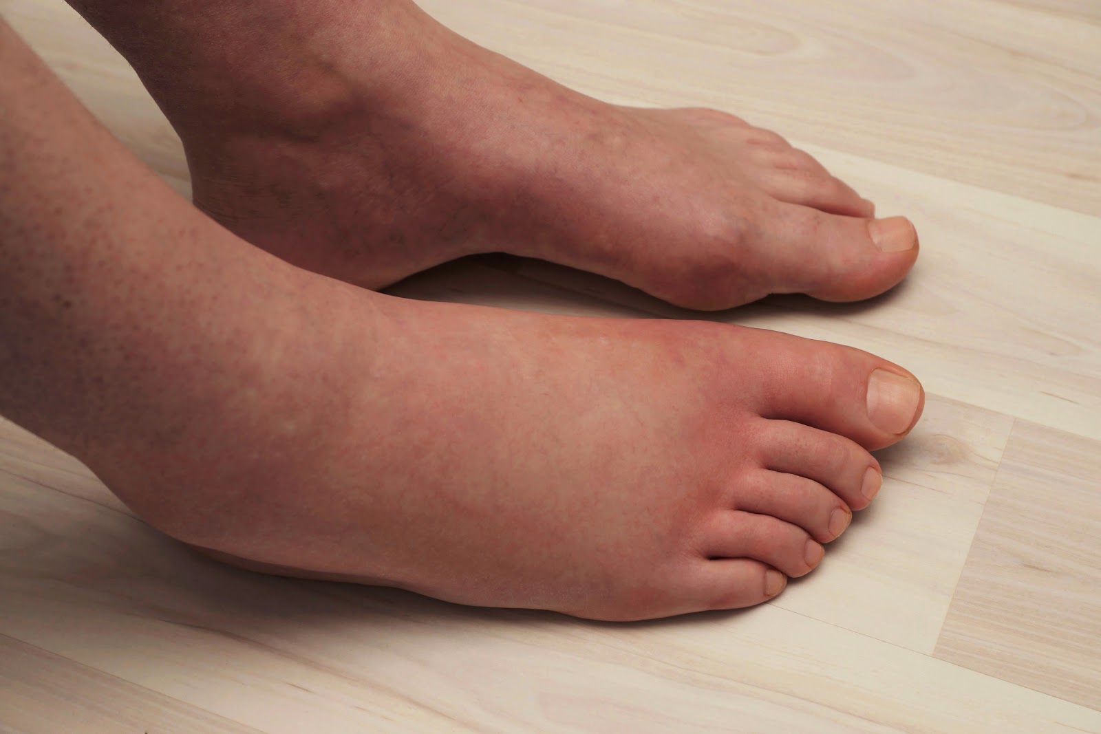 How High Blood Pressure Affects Your Feet Kansas City Foot Specialists