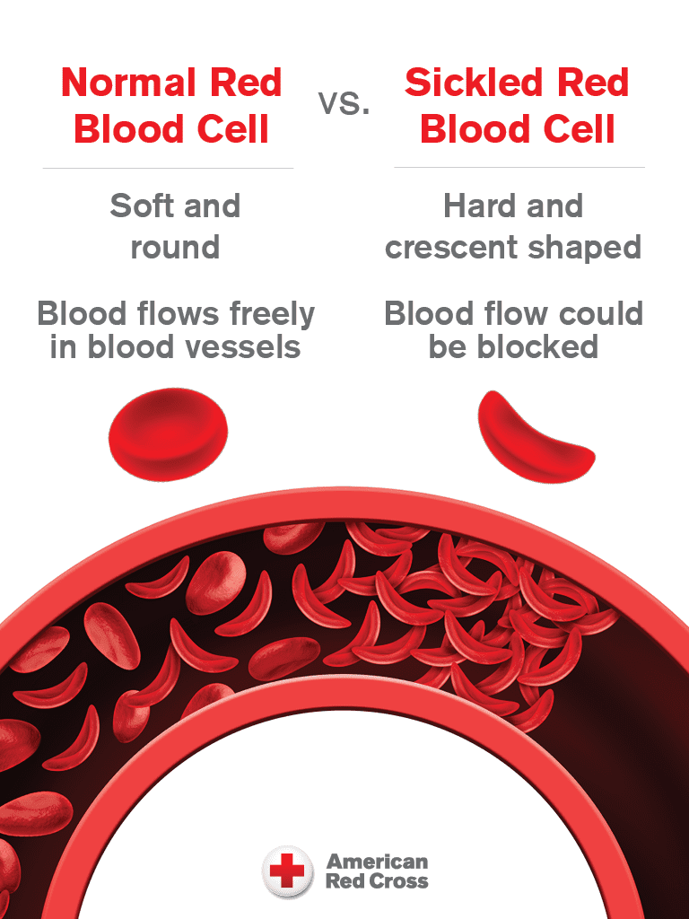 Help Ease Patient Pain During Sickle Cell Awareness Month KCLY Radio