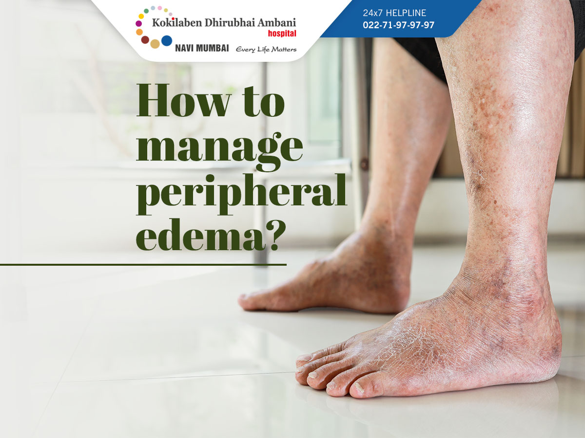 How to manage peripheral edema?
