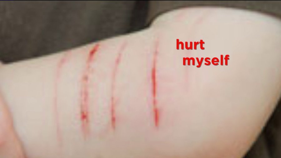 Disturbing behavior of ‘selfcutting’ on the rise among teens FOX31