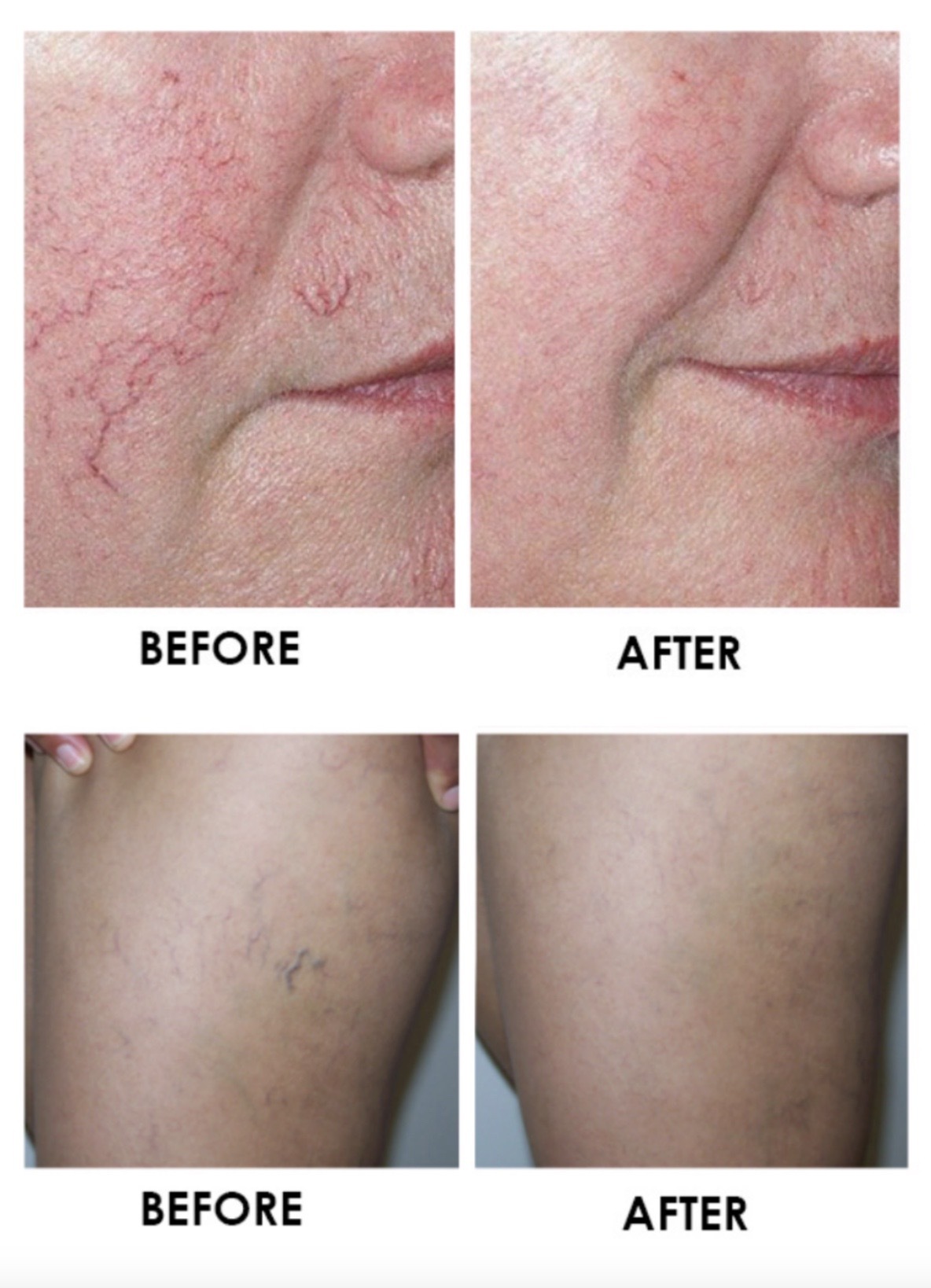 Thread Veins Removal The Laser Clinic Group