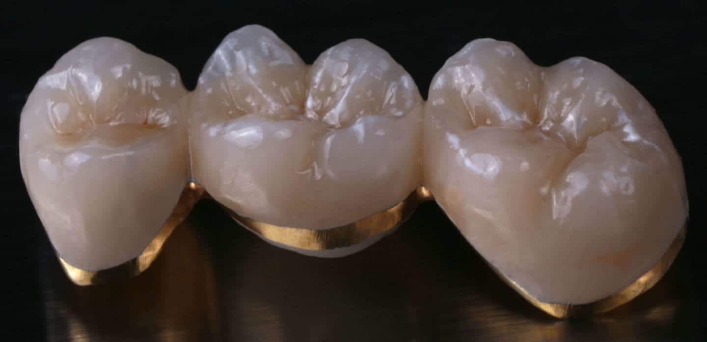 7 Facts to Know About Porcelain Fused to Metal (PFM) Crowns