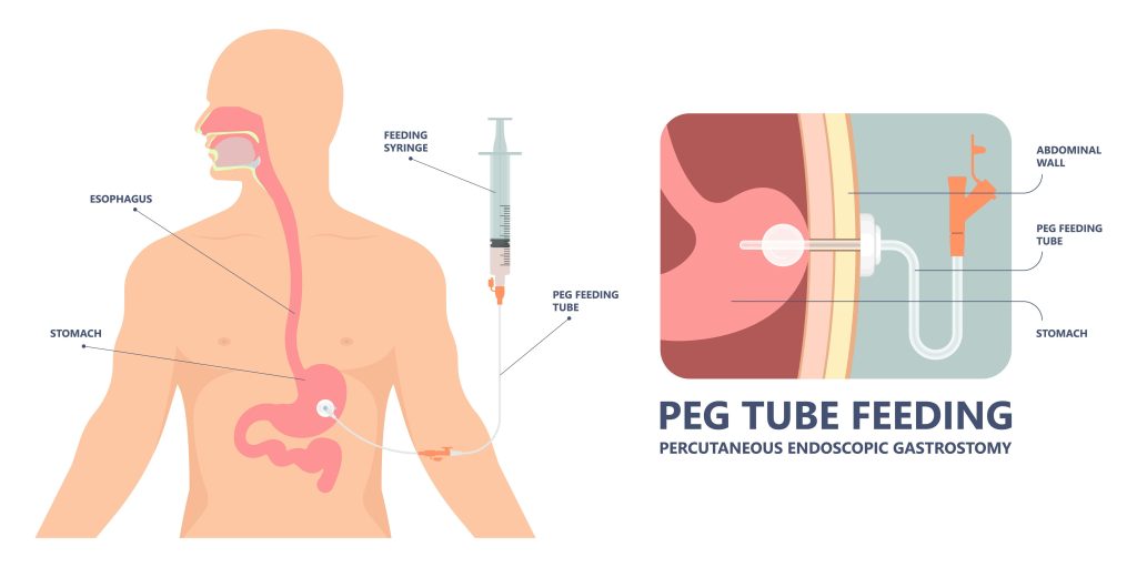 Tube feeding Keeping my chest healthy