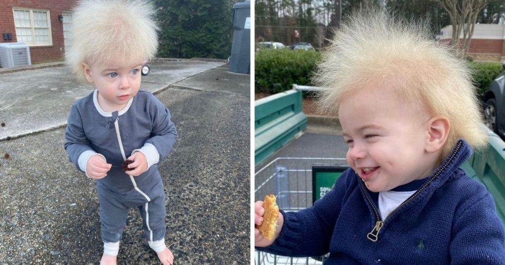 Toddler With Superrare Hair Syndrome’ Spreads Joy On