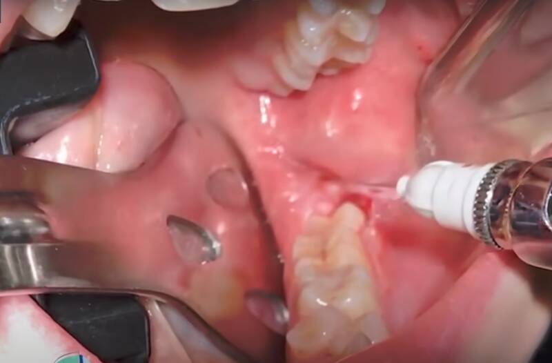 Wisdom Teeth Bleeding Tips for a Speedy Recovery (2023)