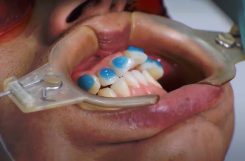 Teeth with Long Roots All You Need to Know