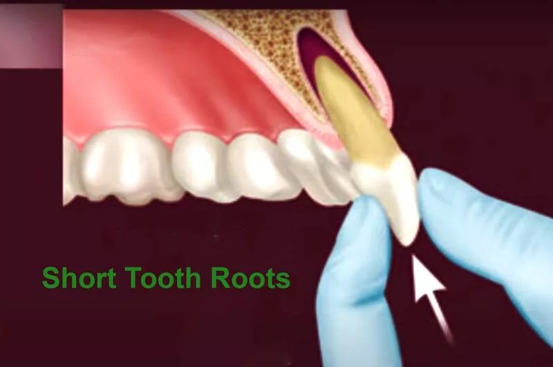 Short Tooth Roots A Closer Look at This Dental Condition