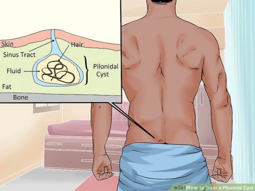 Have you heard of this pain in the rear? A Pilonidal Abscess (or Cyst