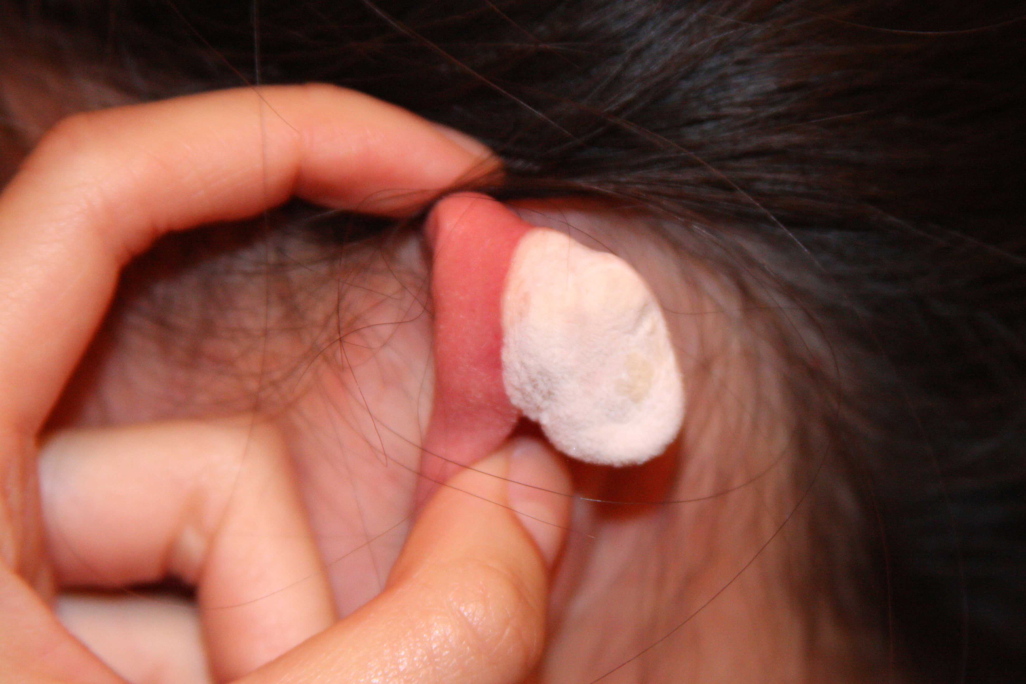 How To Remove Keloid On Ear Escons