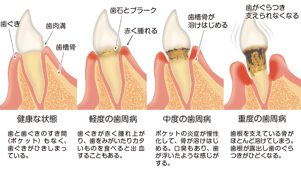 歯周病治療 診療案内 千代県庁口駅から徒歩1分の歯科医院｜県庁前デンタルクリニック｜土・日・祝日も診療