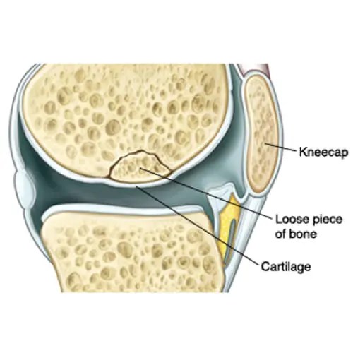 Osteochondral Defect Dr. Bramlett Birmingham, Alabama