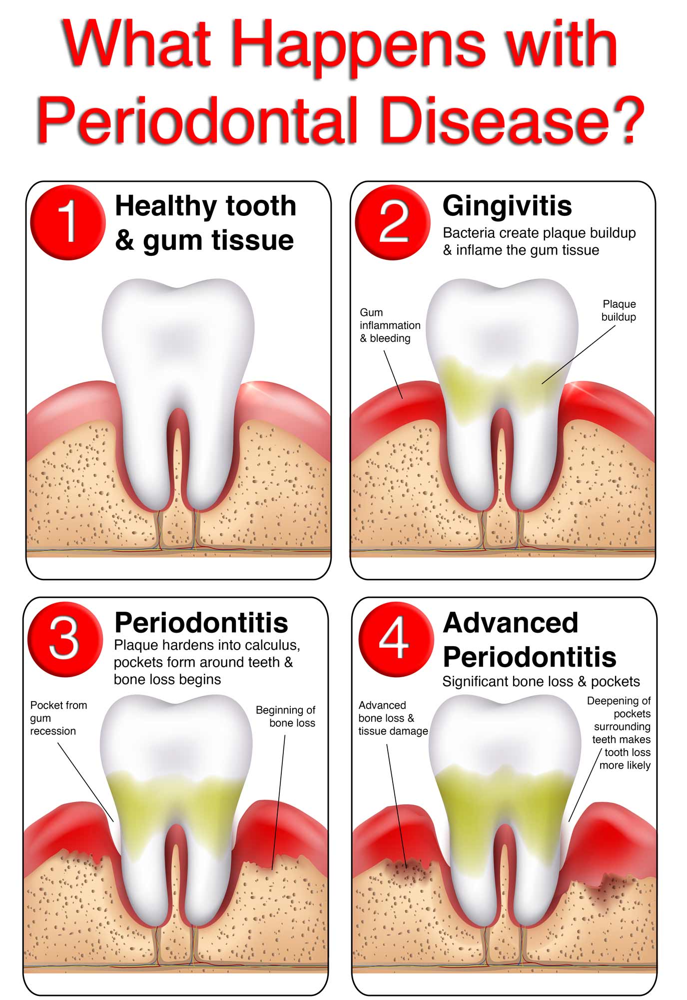 Periodontitis Treatment