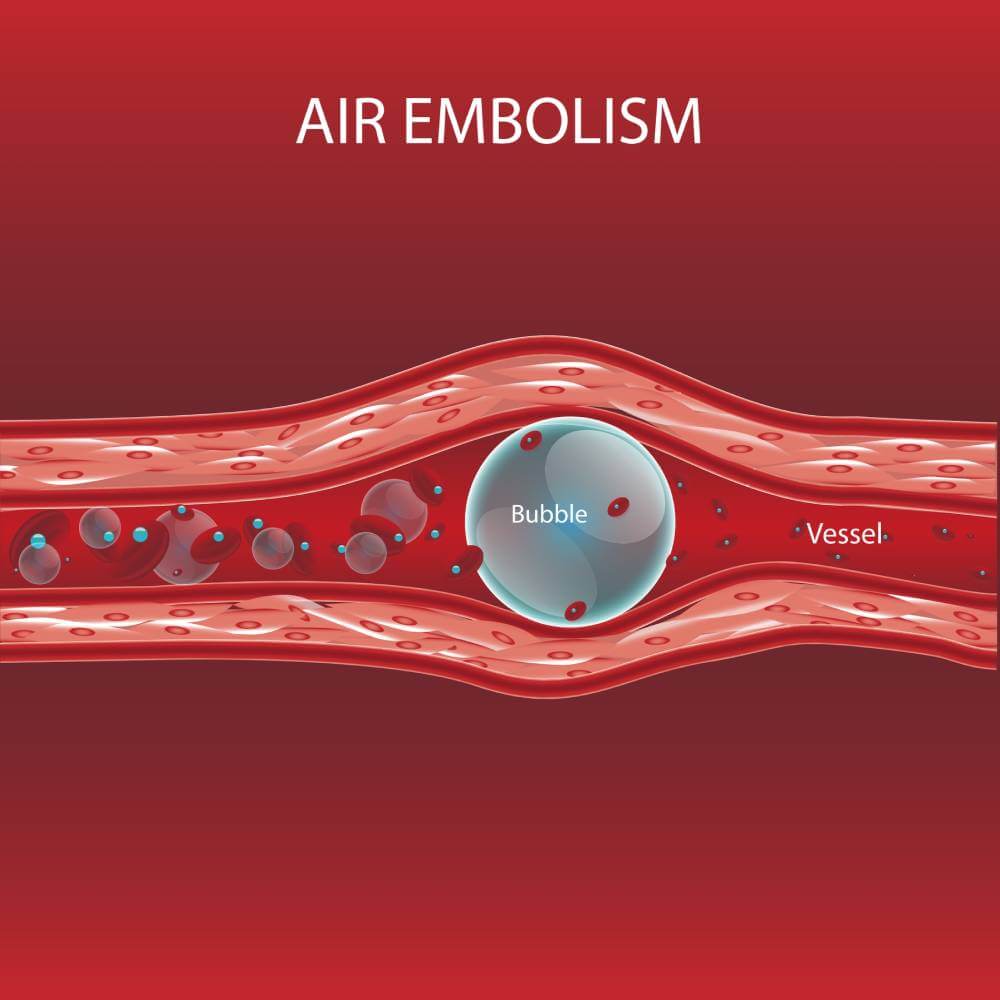 Risk of Gas Embolism During Invasive Procedures