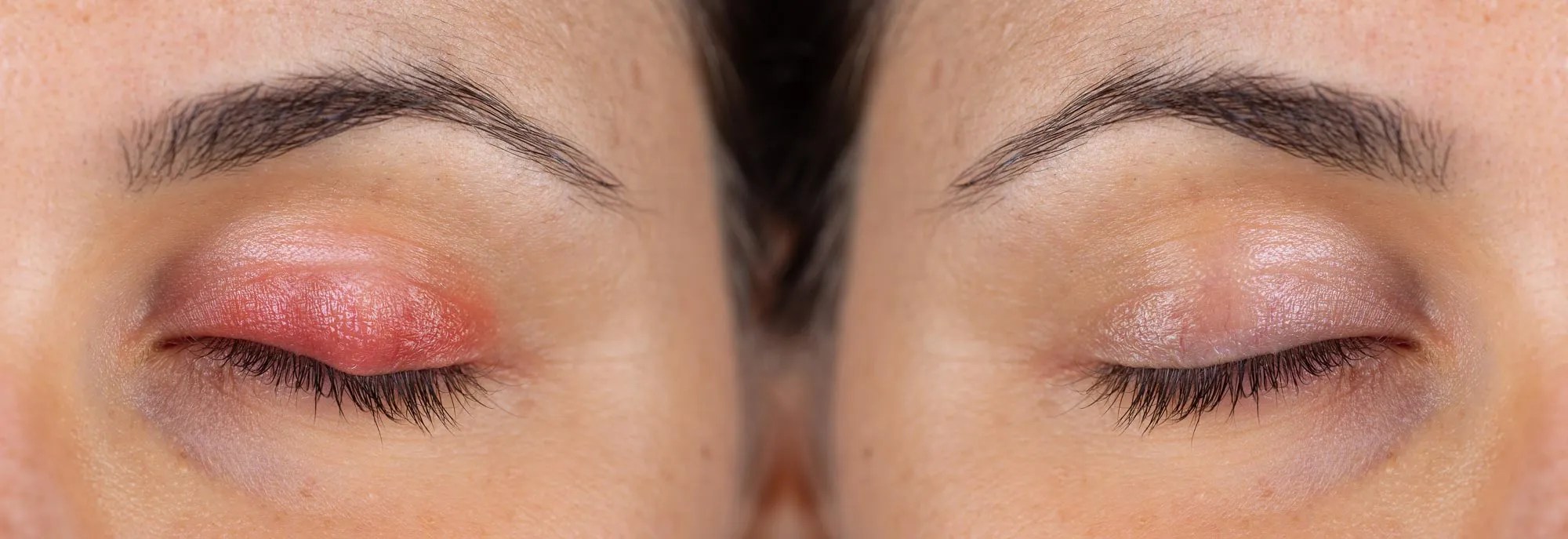 Blepharitis Kenyon Opticians Bingley