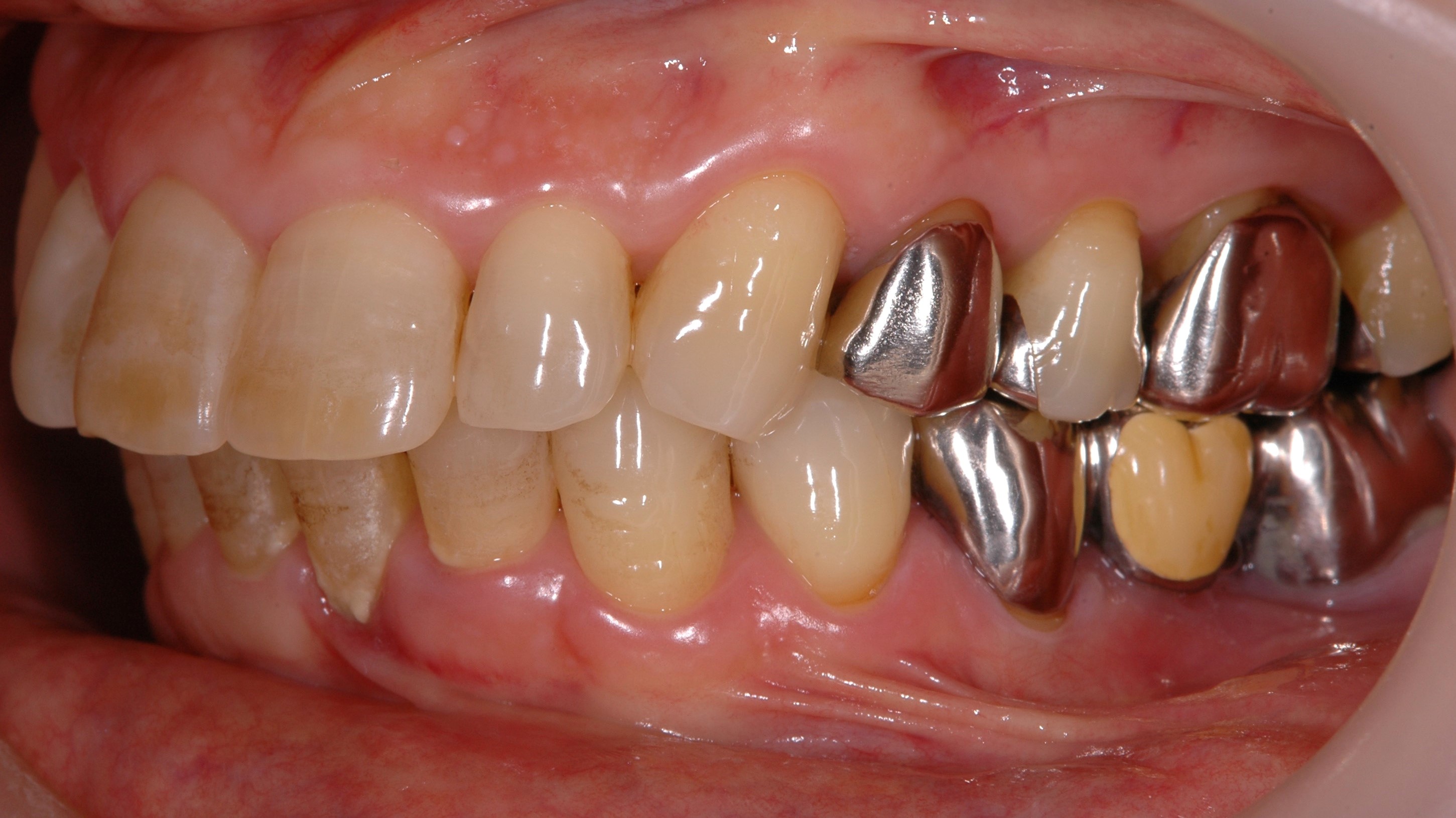 奥歯が無い方必見！奥歯の歯周病治療、歯槽膿漏って治るの？諦める前にご相談ください！！ 健造デンタルクリニック