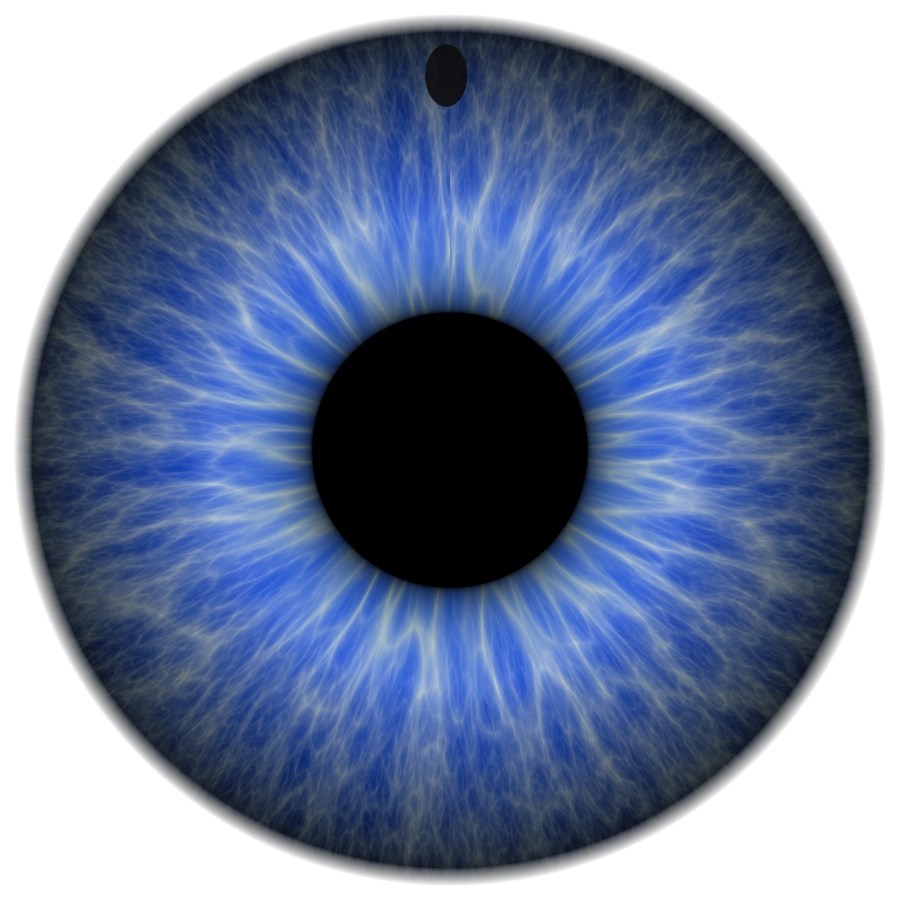 Laser peripheral iridotomy Kersley Eye Clinic London