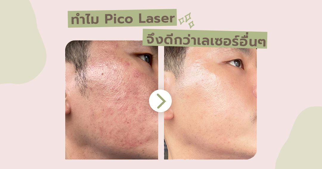ทำไม Pico Laser จึงดีกว่าเลเซอร์อื่นๆ KeTHAT Clinic