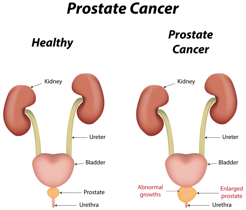 Using Diet to Help Prevent Prostate Cancer Blog