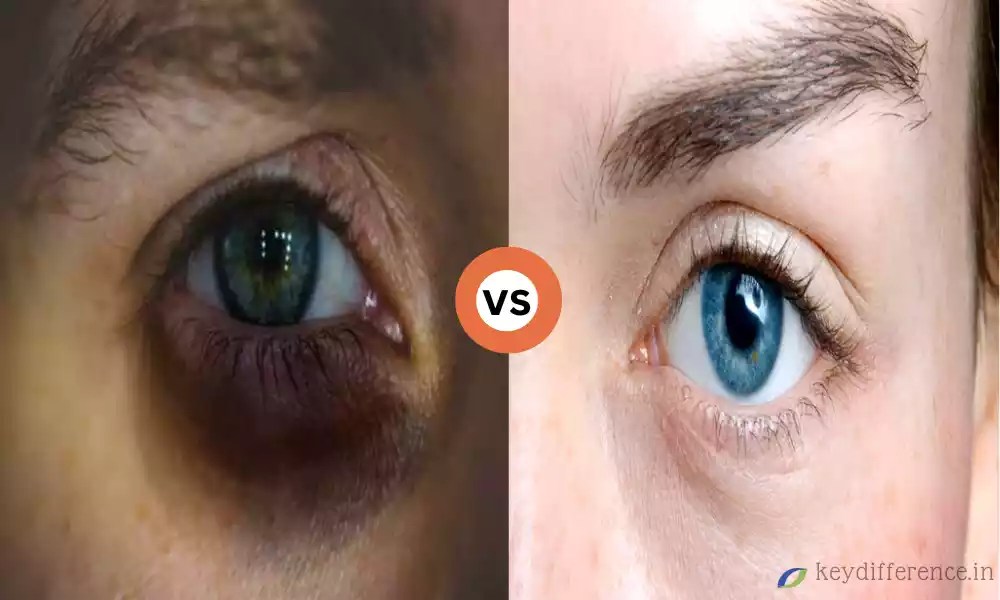 What is 9 the Difference Between Eye Bags and Dark Circles Key Difference