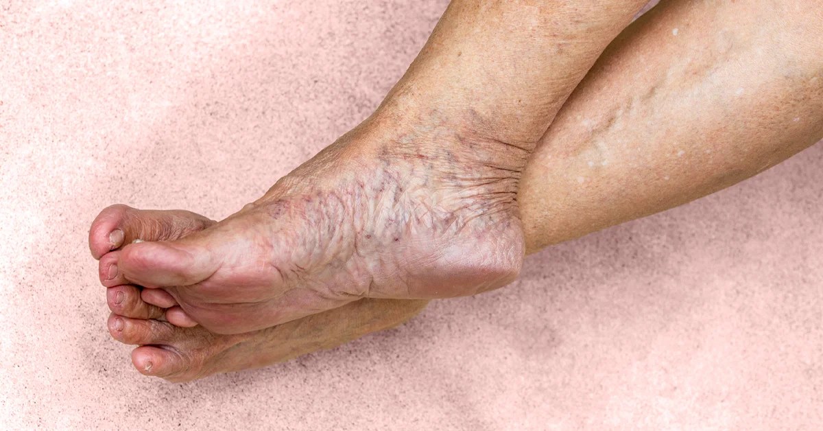 Top 7 Difference Between Lymphedema and Venous Insufficiency Key