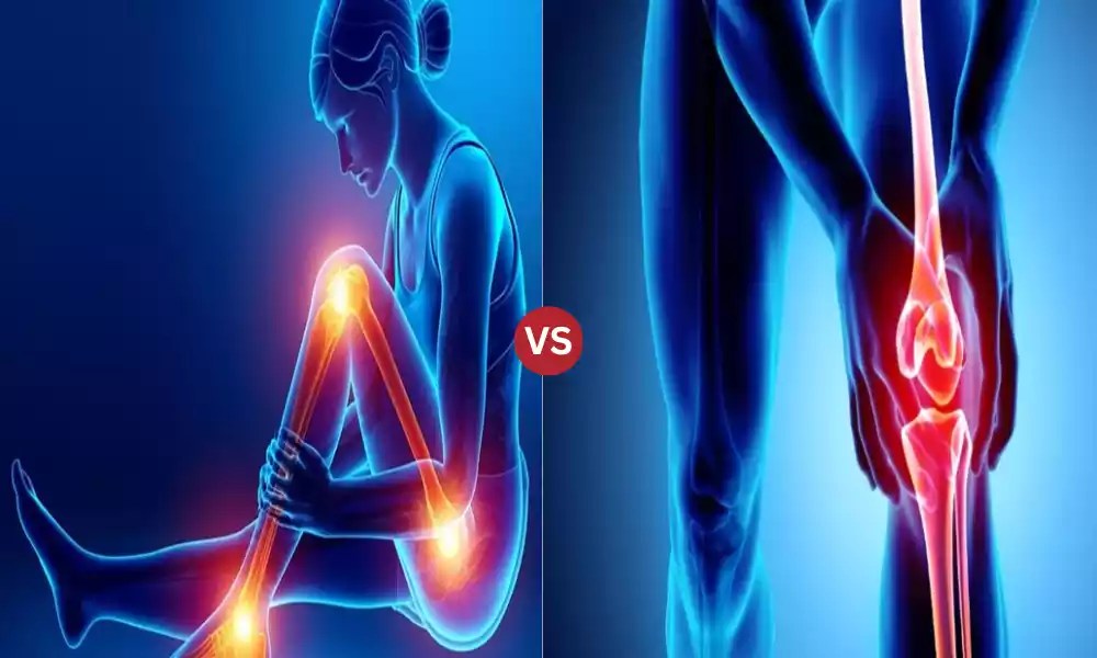 TOP 9 Difference Between Arthritis and Osteoarthritis Key Difference