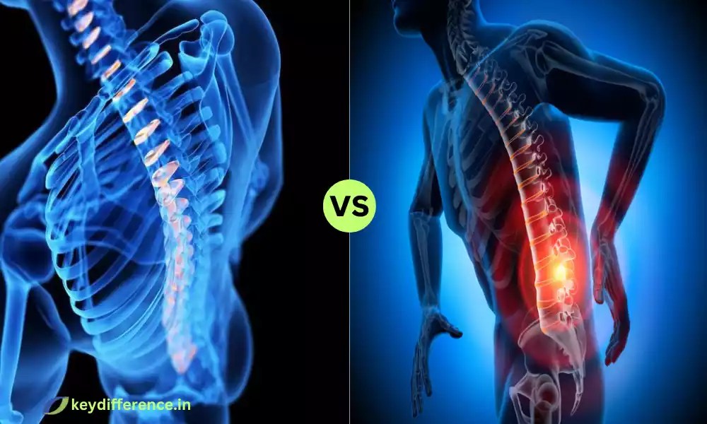 Difference Between Herniated and Bulging Disc Key Difference