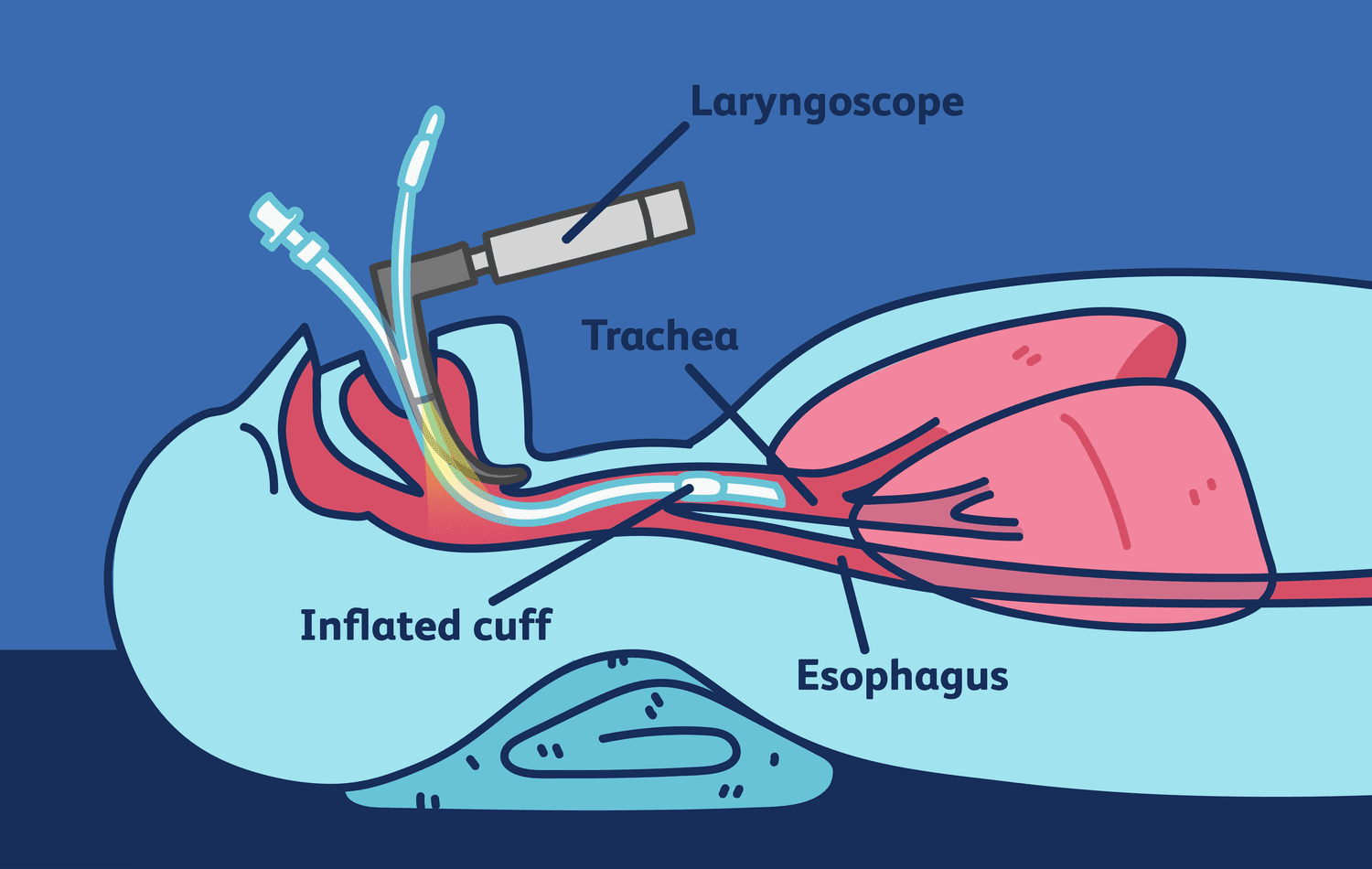 Best 9 Difference Between Rapid Sequence Intubation and Normal