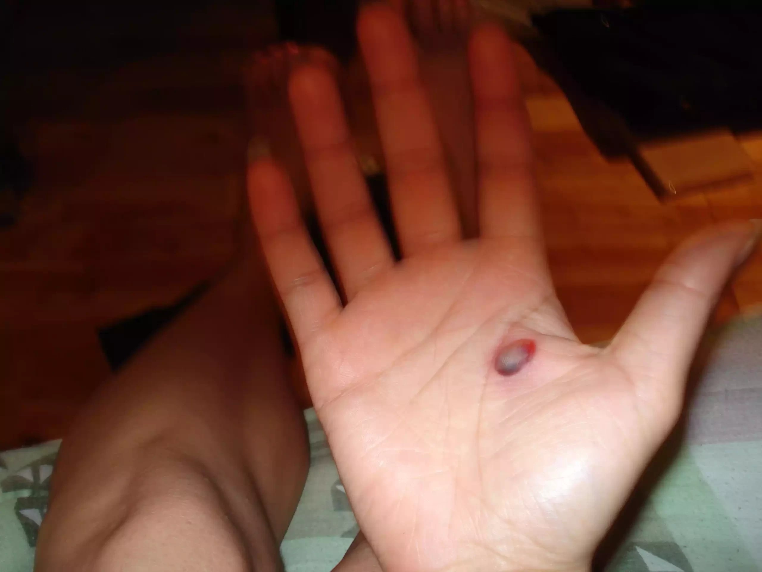 Difference Between Blood Blister and Melanoma