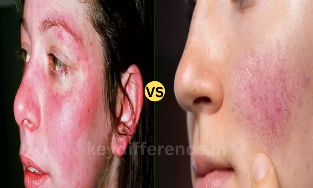 Difference Between Malar Rash and Rosacea