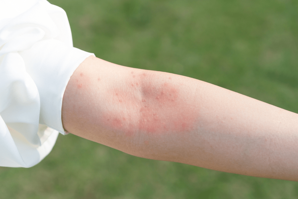 4 Common Types of Rashes and How to Treat Them Keystone RX