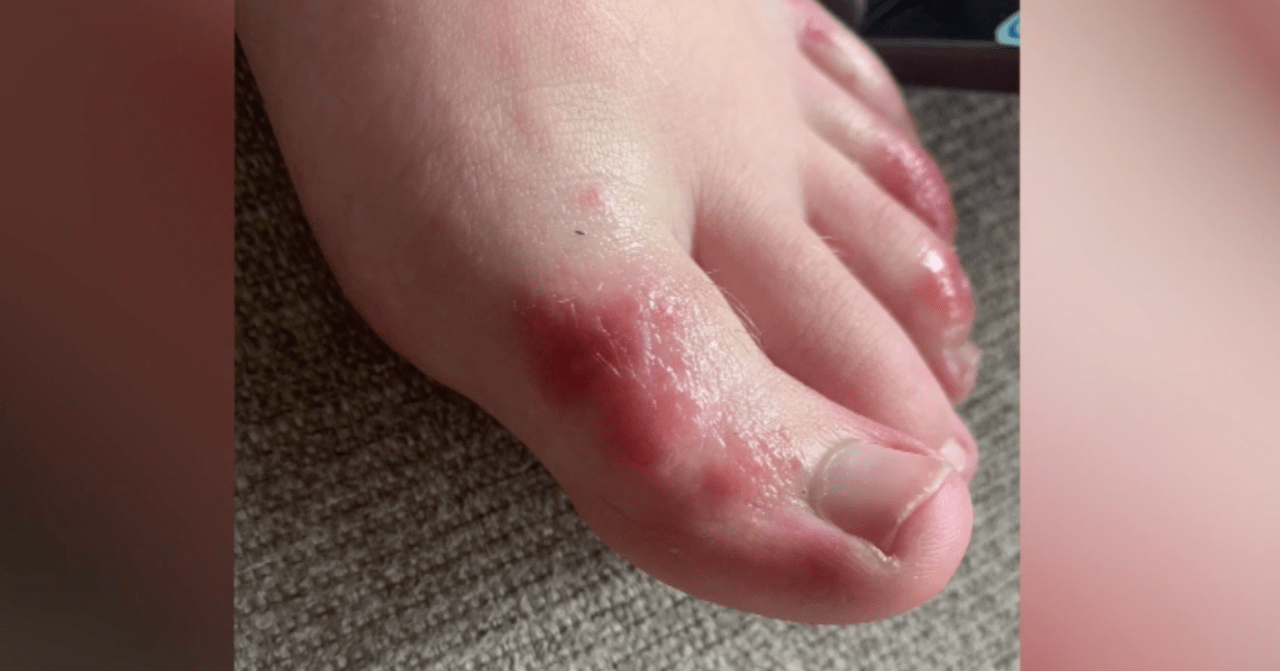 COVID toes Mysterious rash can affect feet in patients with
