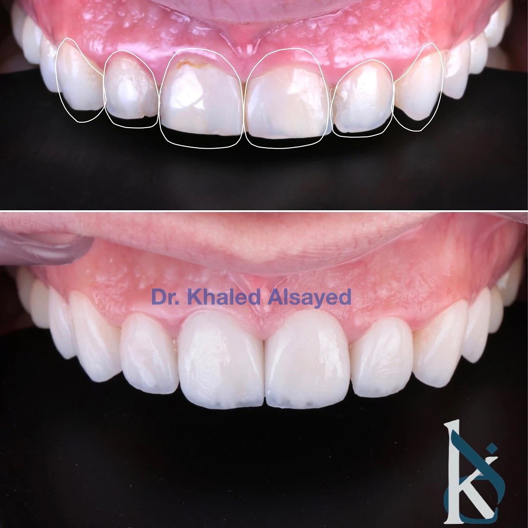 Porcelain Veneers & Smile Makeovers Khaled Al Sayed Dentistry