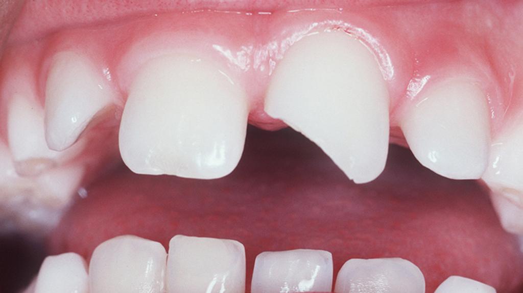 Fractured permanent front teeth Kid Focus Dentistry