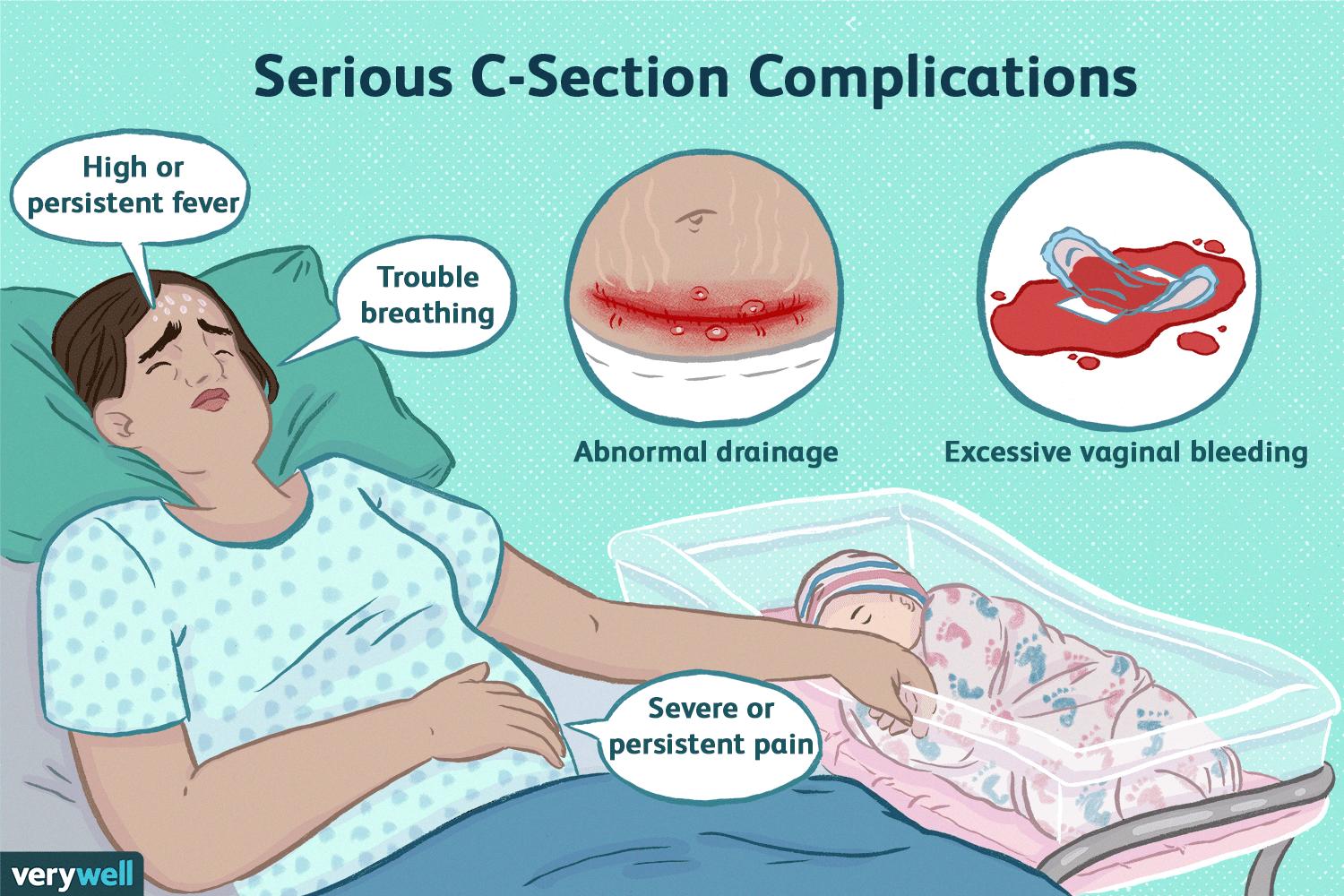 Complete Bed Rest After C Section at Veronica Jernigan blog