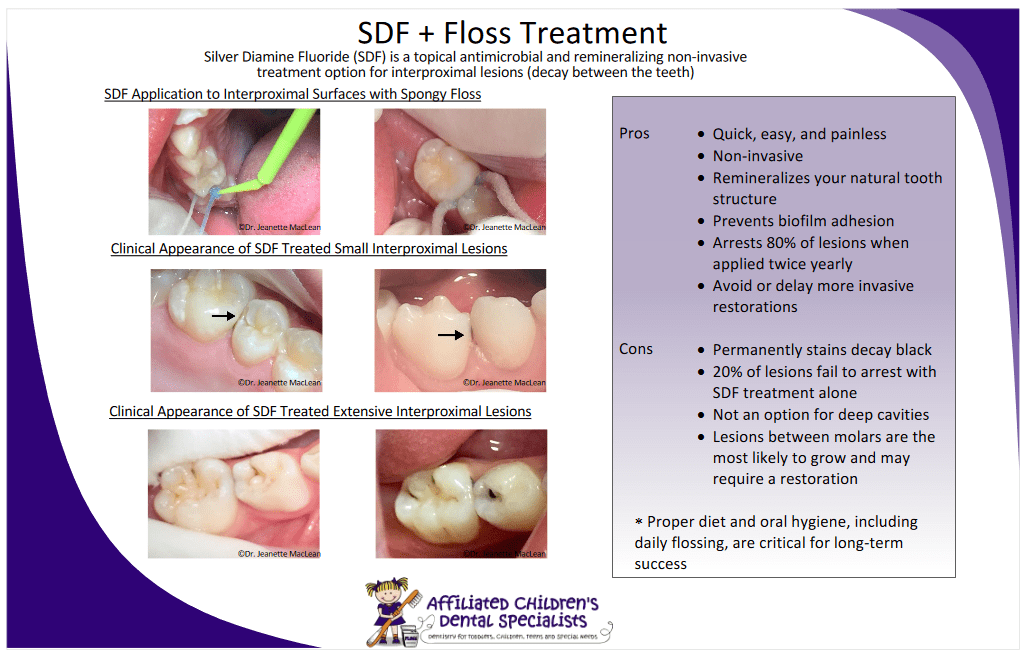 Silver Diamine Fluoride Affiliated Children's Dental Specialists