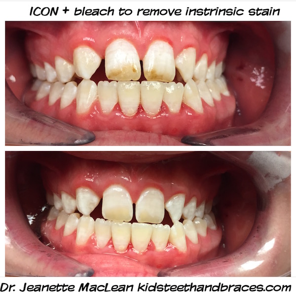 ICON Resin Infiltration Affiliated Children's Dental Specialists
