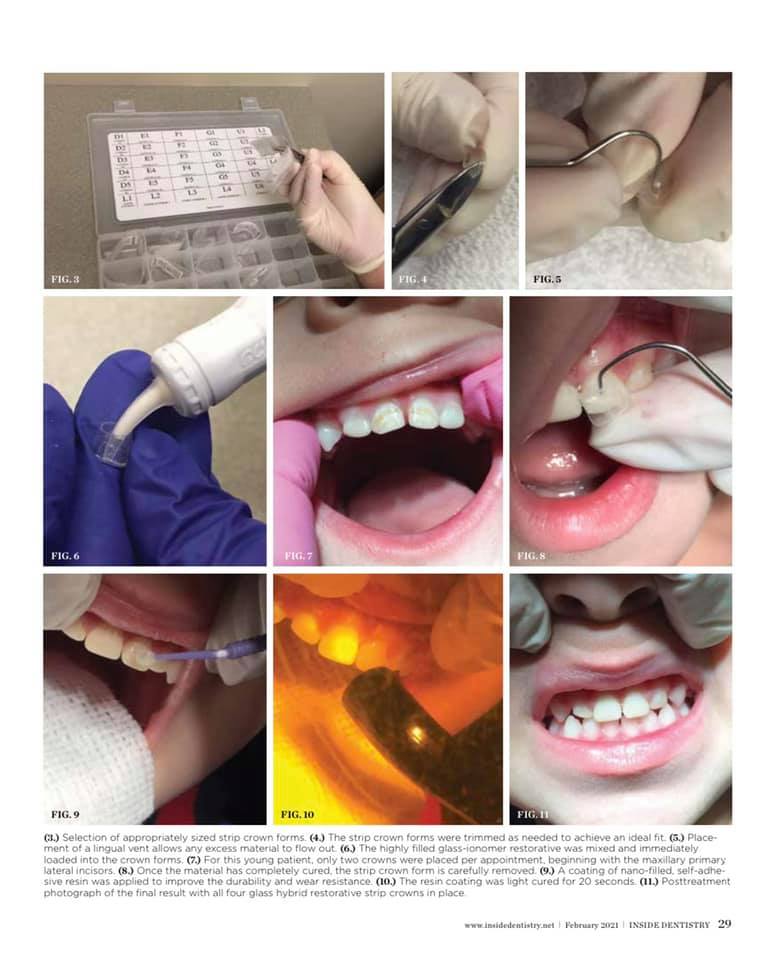 Atraumatic Strip Crown Article Featured in Inside Dentistry