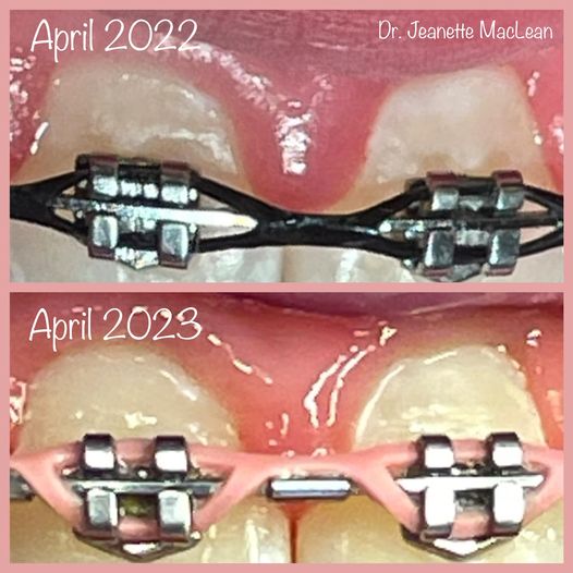 curodont_brackets Affiliated Children's Dental Specialists