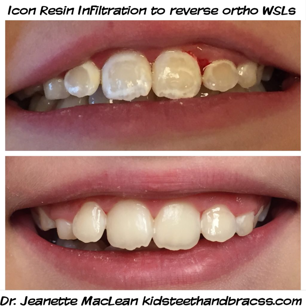 Icon Resin Infiltration (ICON) Affiliated Children's Dental
