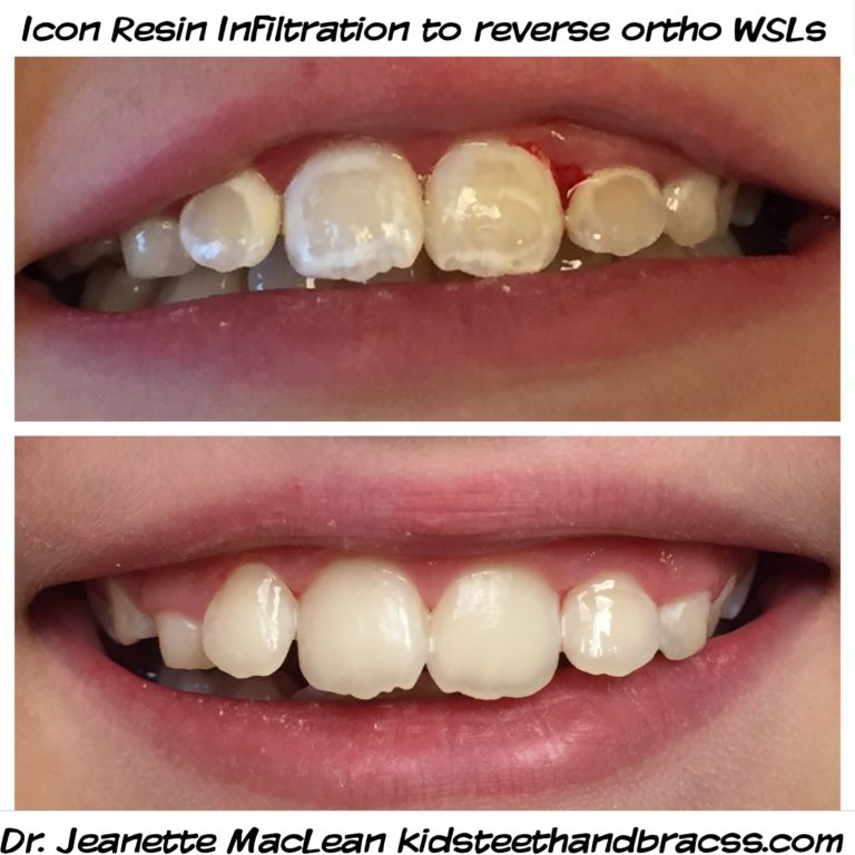 Icon Resin Infiltration (ICON) Affiliated Children's Dental Specialists