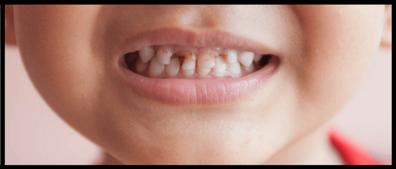 Baby Bottle Tooth Decay Old Bridge Pediatric Dentist