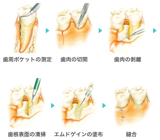 歯周病治療｜新柴又駅の歯医者｜木暮歯科クリニック