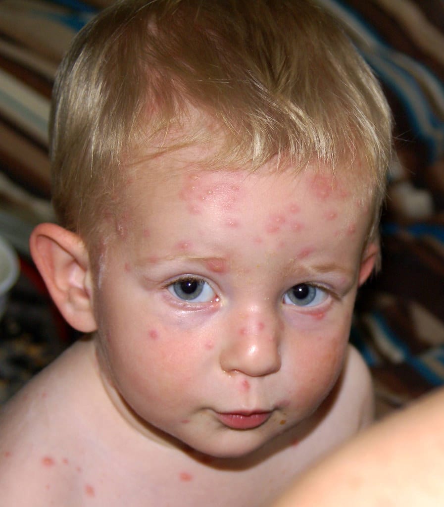 Chickenpox Everything You Need To Know Kinacle