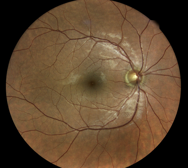 5 Macular Degeneration Facts KindSIGHT Eye Specialists