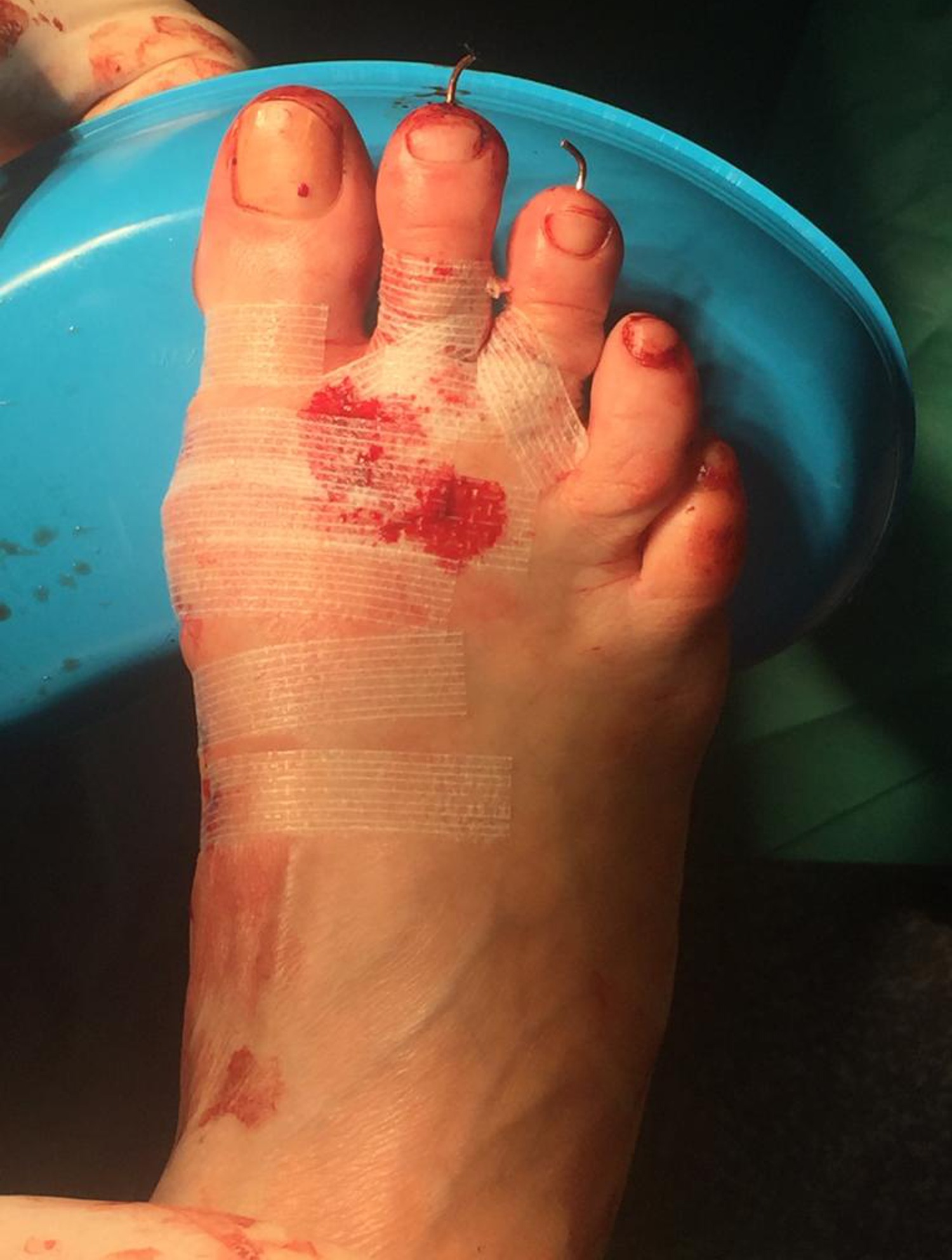 Hallux valgus correction (Bunion surgery) Gallery Kinvara Private