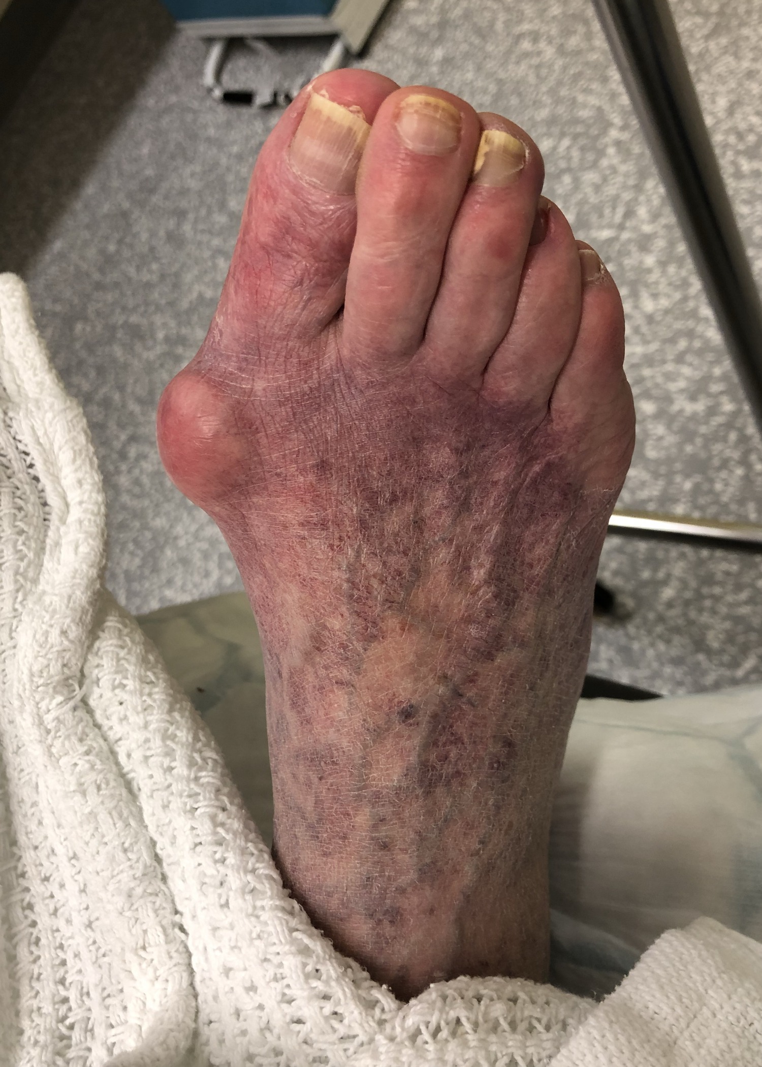Hallux valgus correction (Bunion surgery) Gallery Kinvara Private