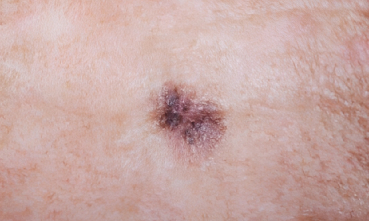 Understanding Skin Cancer Symptoms Early Detection