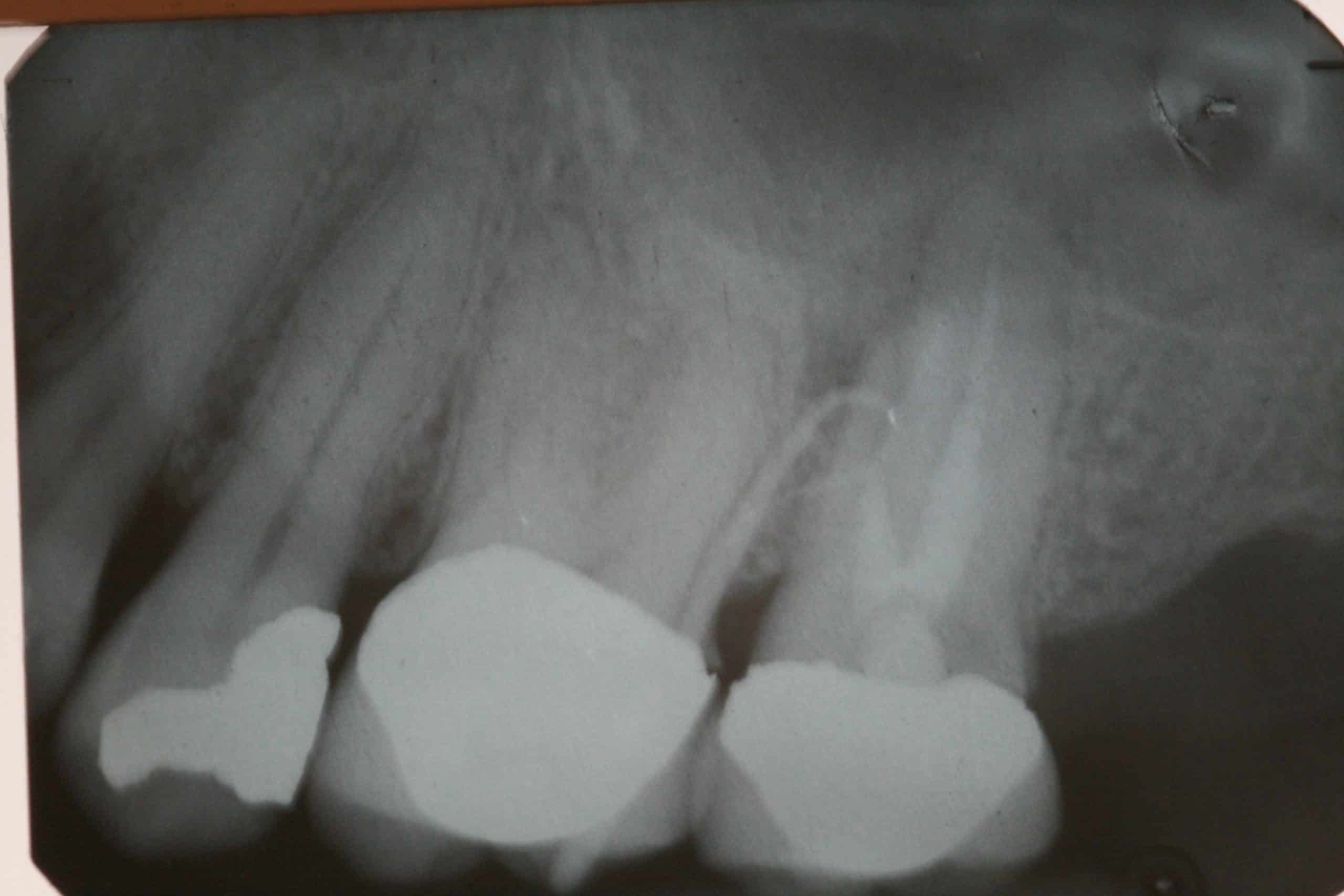 Oral Fistula Traced Advanced Dentistry & Dental Implant Center
