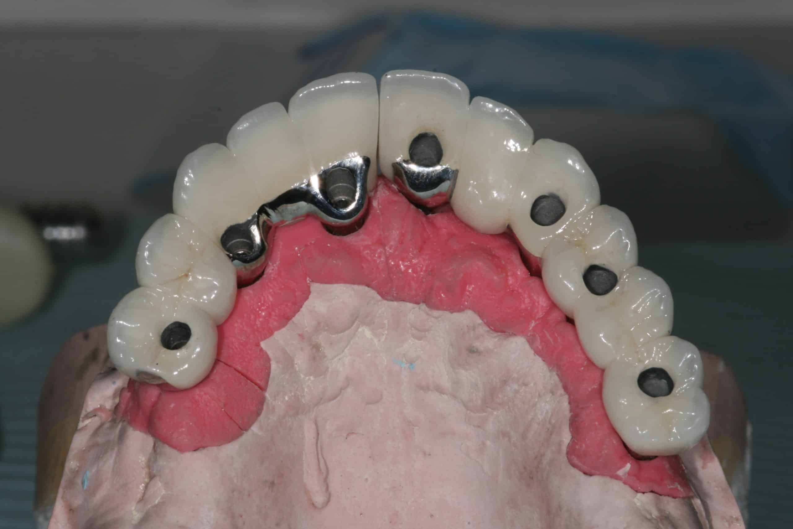 Case 2 Maxillary Full Arch Fixed Screwed (FP2) Advanced Dentistry
